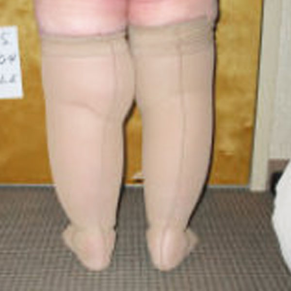 Lower Extremity Lymphedema and Edema
